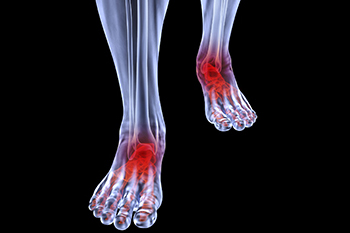 arthritic foot care in the Nevada County, CA: Grass Valley (Union Hill, Truckee, Peardale, Willow Valley, La Barr Meadows, Alta Sierra, Nevada City), as well as Placer County, CA: Roseville, Lincoln, Auburn, and Sutter County, CA: Yuba City, Live Oak areas