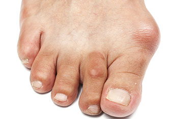 bunions treatment and removal in the Nevada County, CA: Grass Valley (Union Hill, Truckee, Peardale, Willow Valley, La Barr Meadows, Alta Sierra, Nevada City), as well as Placer County, CA: Roseville, Lincoln, Auburn, and Sutter County, CA: Yuba City, Live Oak areas