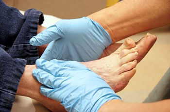 diabetic foot care and non-healing wounds treatment in the Nevada County, CA: Grass Valley (Union Hill, Truckee, Peardale, Willow Valley, La Barr Meadows, Alta Sierra, Nevada City), as well as Placer County, CA: Roseville, Lincoln, Auburn, and Sutter County, CA: Yuba City, Live Oak areas