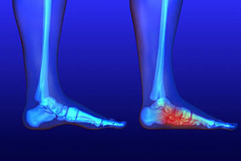 flat feet treatment in the Nevada County, CA: Grass Valley (Union Hill, Truckee, Peardale, Willow Valley, La Barr Meadows, Alta Sierra, Nevada City), as well as Placer County, CA: Roseville, Lincoln, Auburn, and Sutter County, CA: Yuba City, Live Oak areas