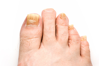 toenail fungus treatment in the Nevada County, CA: Grass Valley (Union Hill, Truckee, Peardale, Willow Valley, La Barr Meadows, Alta Sierra, Nevada City), as well as Placer County, CA: Roseville, Lincoln, Auburn, and Sutter County, CA: Yuba City, Live Oak areas