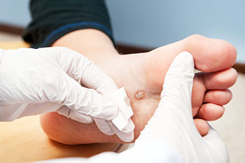 plantar warts treatment in the Nevada County, CA: Grass Valley (Union Hill, Truckee, Peardale, Willow Valley, La Barr Meadows, Alta Sierra, Nevada City), as well as Placer County, CA: Roseville, Lincoln, Auburn, and Sutter County, CA: Yuba City, Live Oak areas