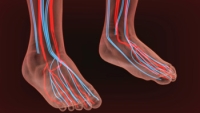 Causes of Peripheral Vascular Disease