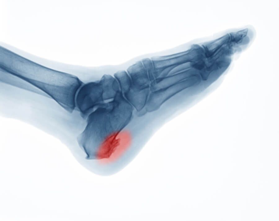 The 2 Common Types of Heel Spurs