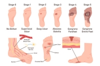 Symptoms and Treatments of Neuropathic Foot Ulcers