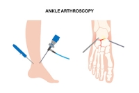 Recovering From Ankle Arthroscopy