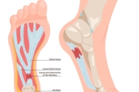 Plantar Fasciitis Facts